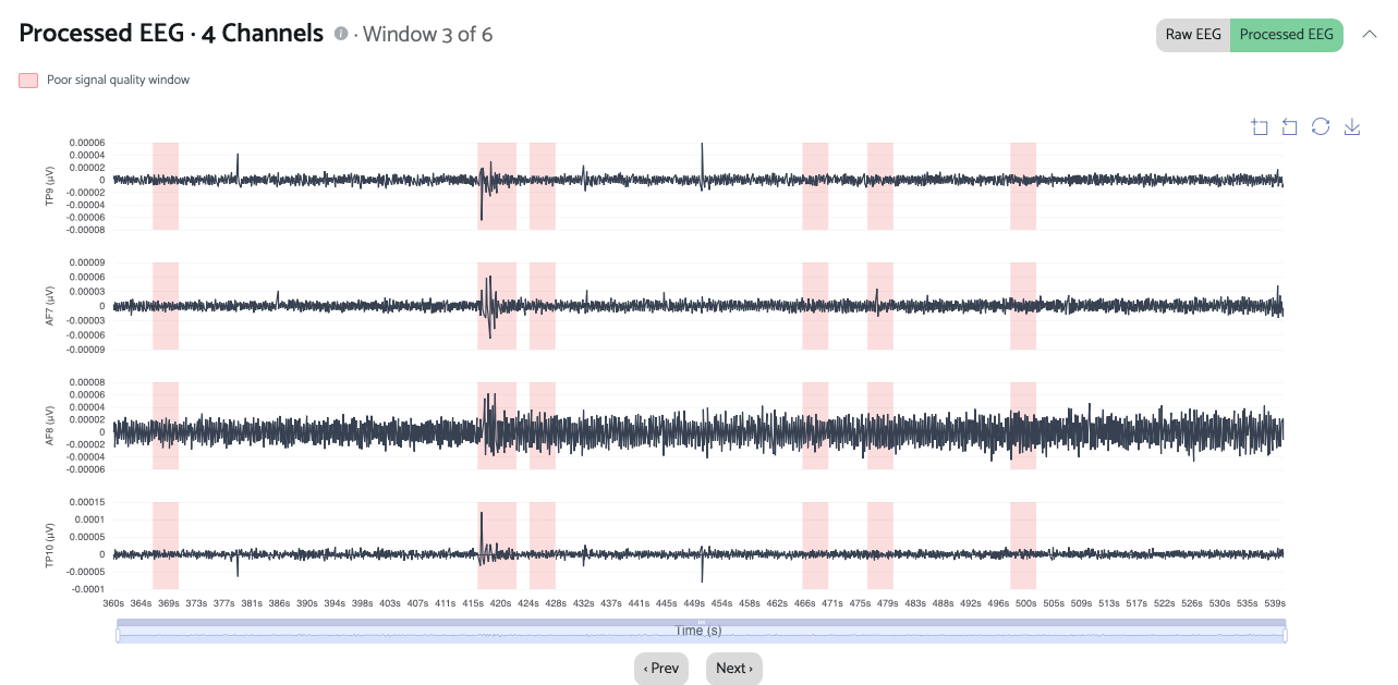 Processed EEG view with poor signal quality windows highlighted